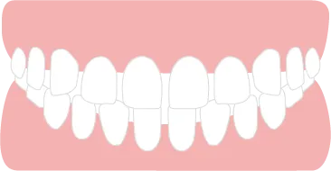 空隙歯列